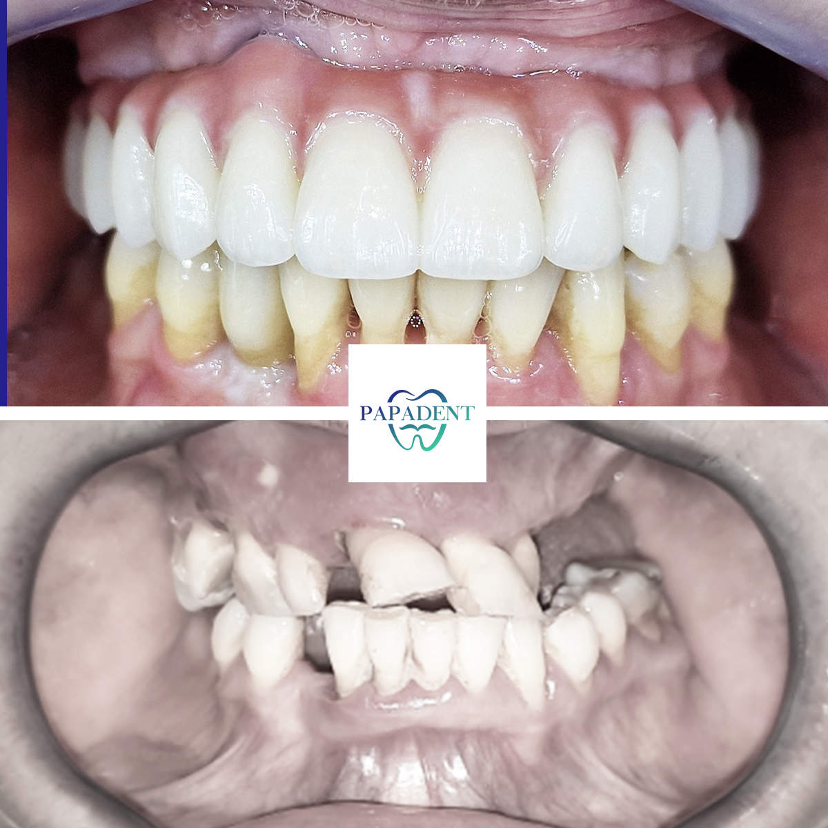 All-on-4-permanent zirconia denture