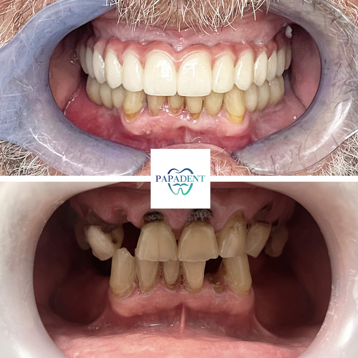 Dainius - Before and after All-on-4 - with mouth open