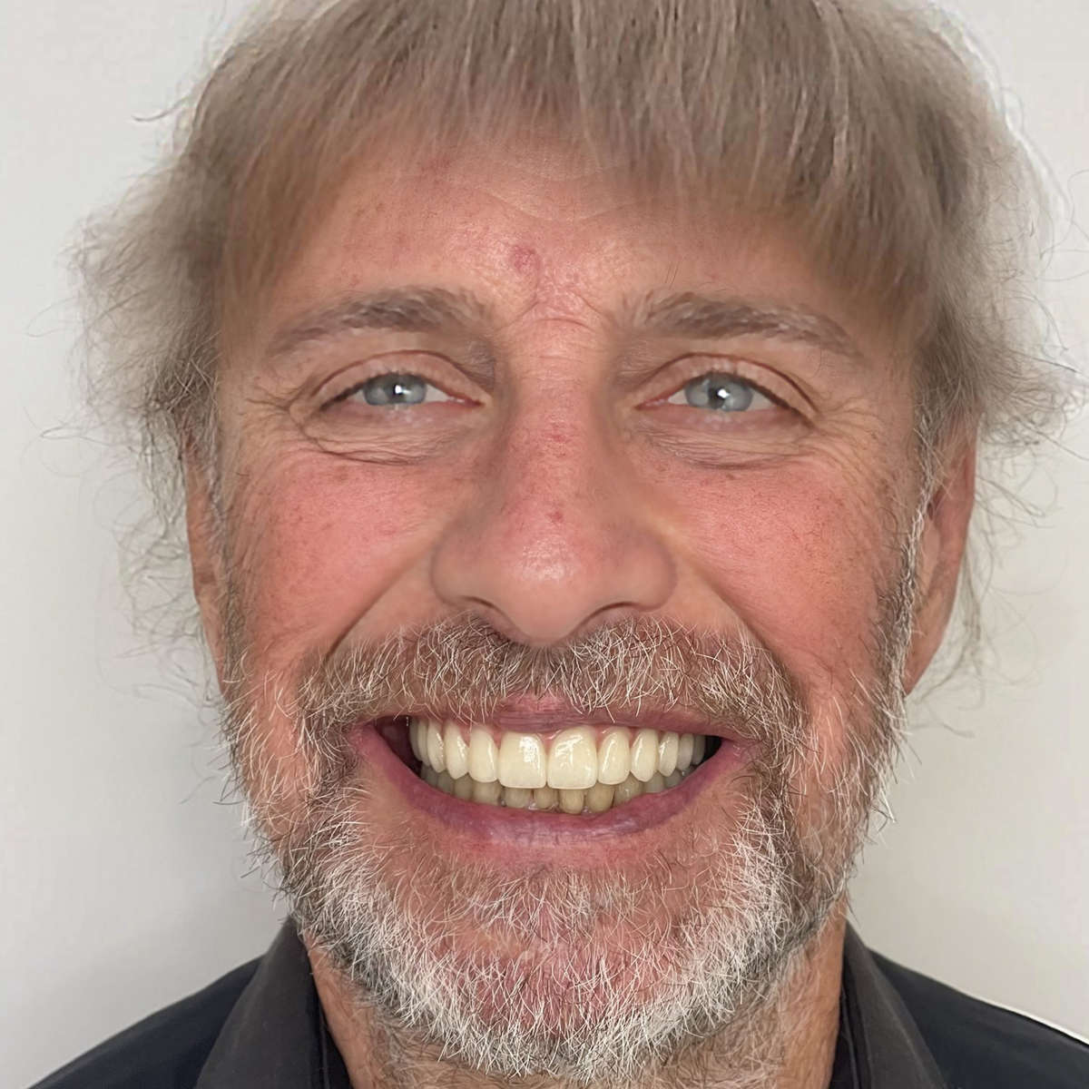 Danius smiles after the All-on-4 implant procedure