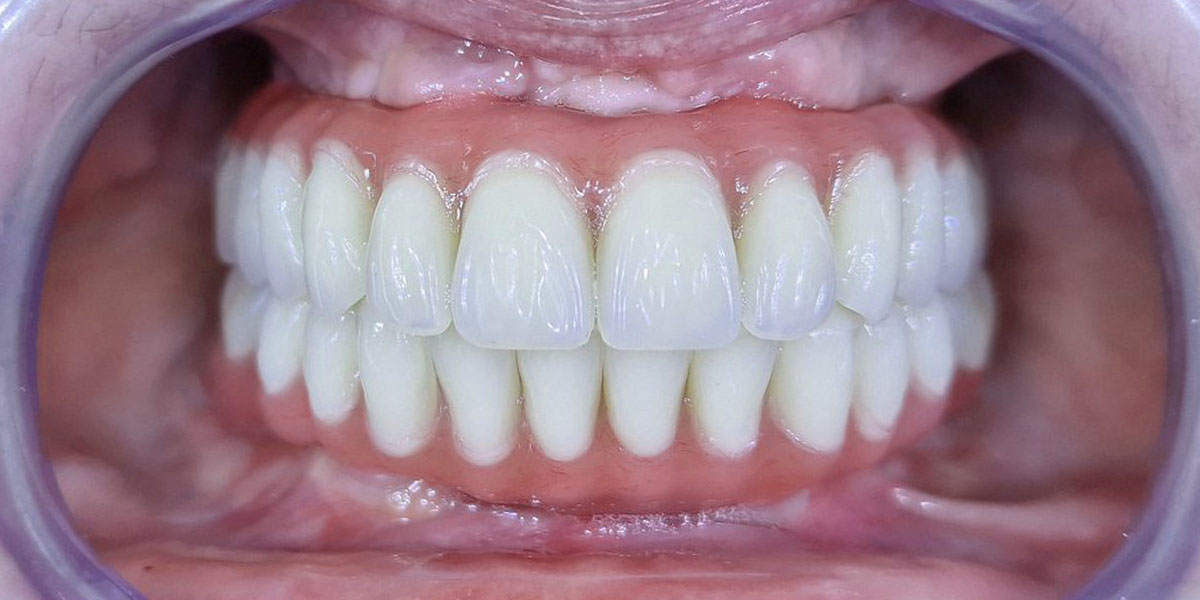 After - Gintarė - 11 maxillary and 8 mandibular teeth removed