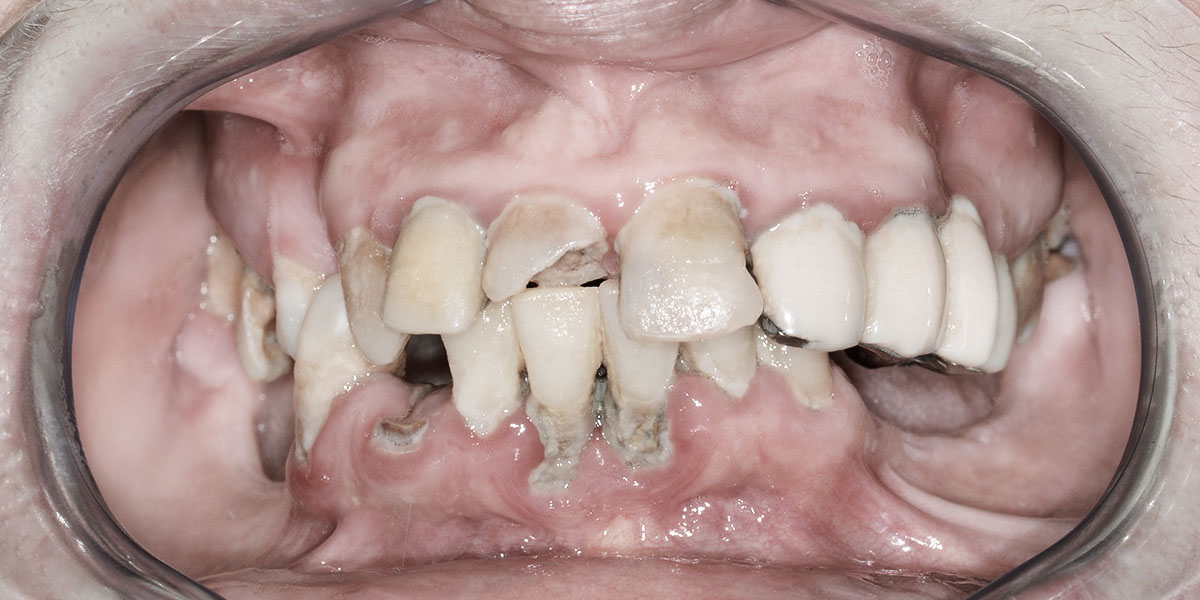 Before - Gintarė - 11 upper and 8 lower jaw teeth removed