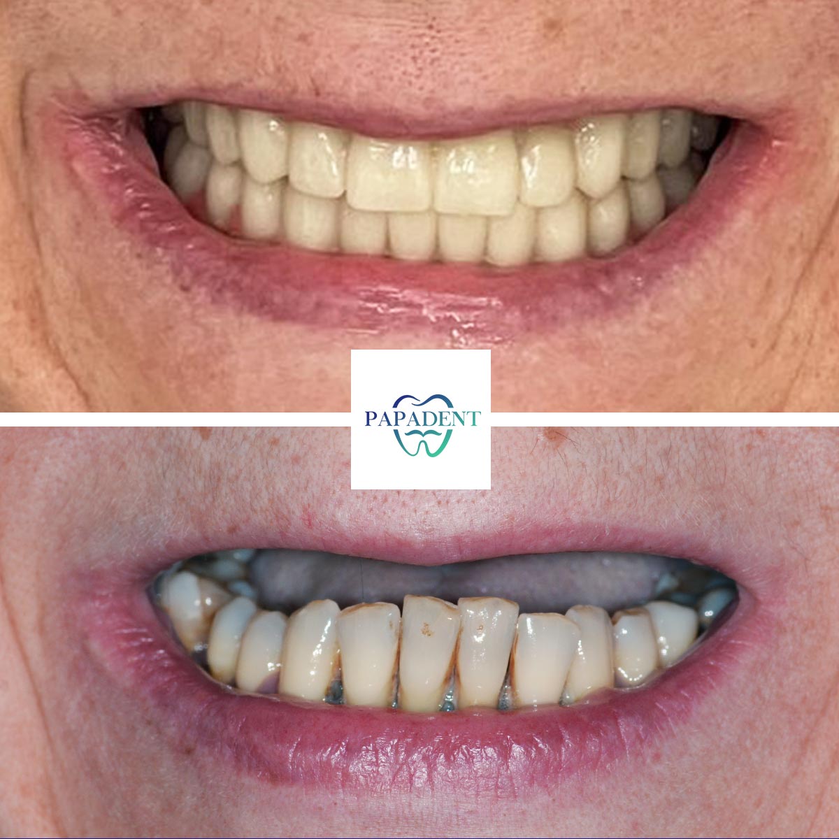 Gražina - All teeth on four implants - Before and after 2