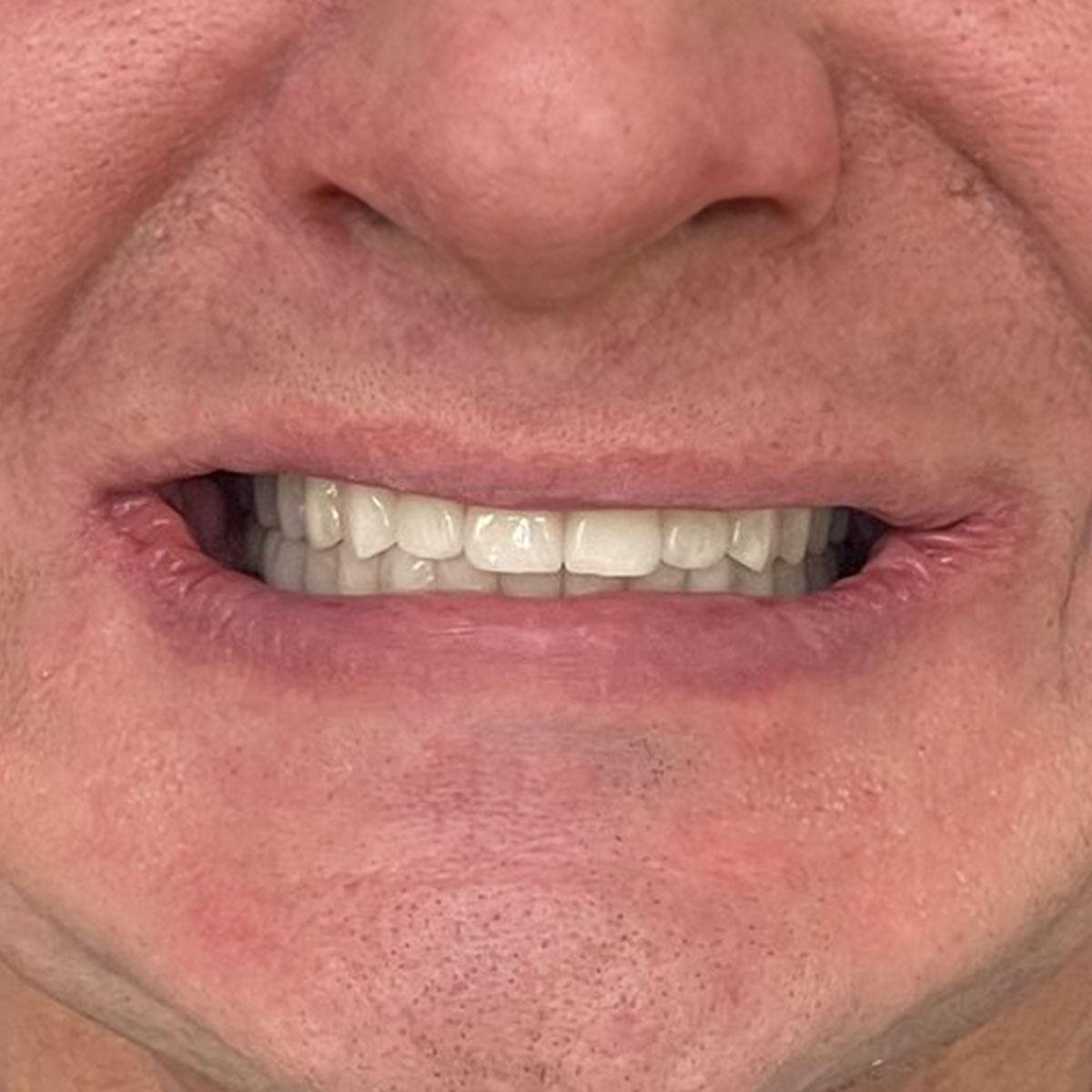 Peter - Full jaw implant case